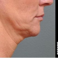 Ultherapy Before & After Patient #1551